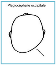 Figure 1: Plagiocéphalie